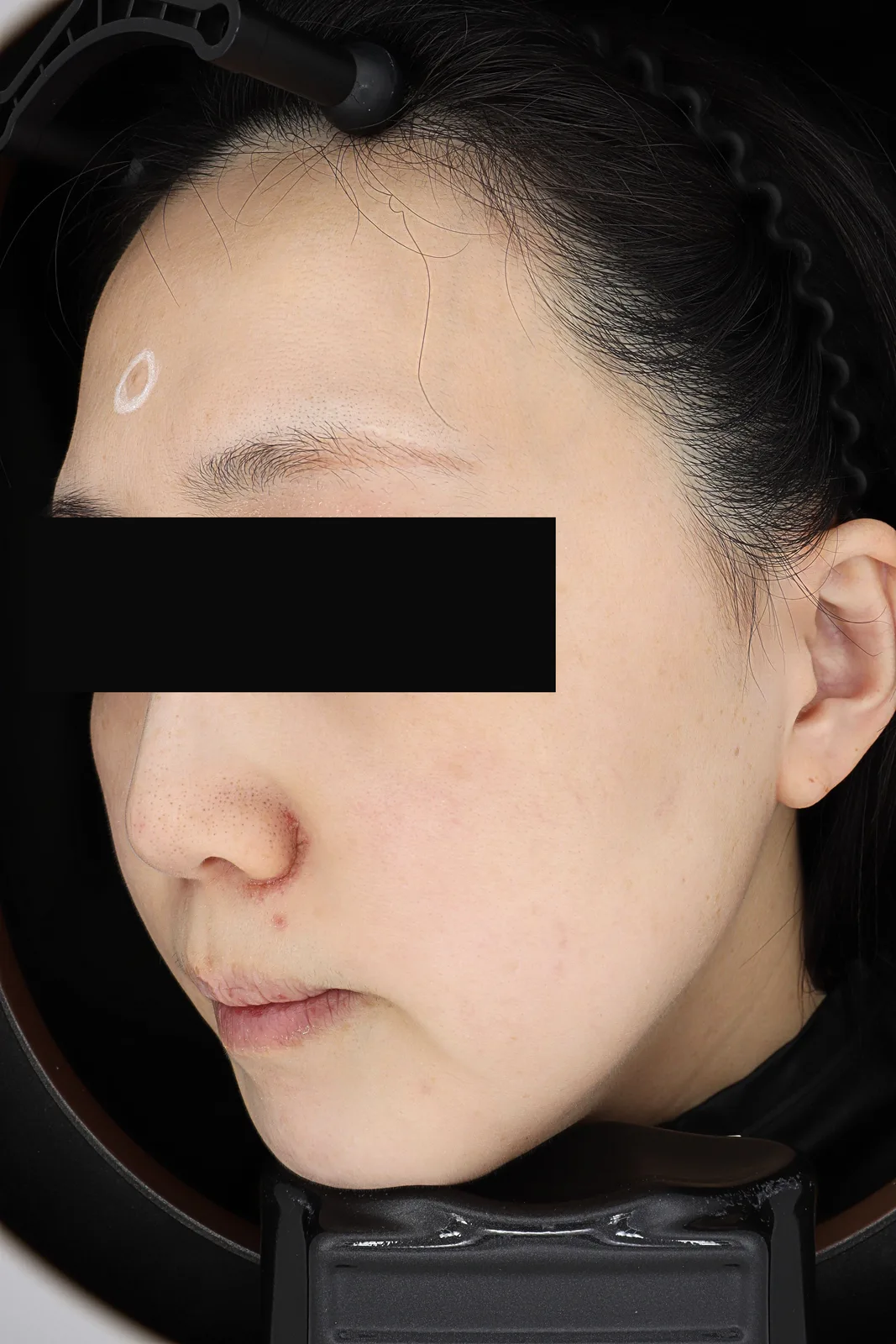 Dark Spot Removal (PicoCare) — After, Kind Global Clinic Myeongdong
