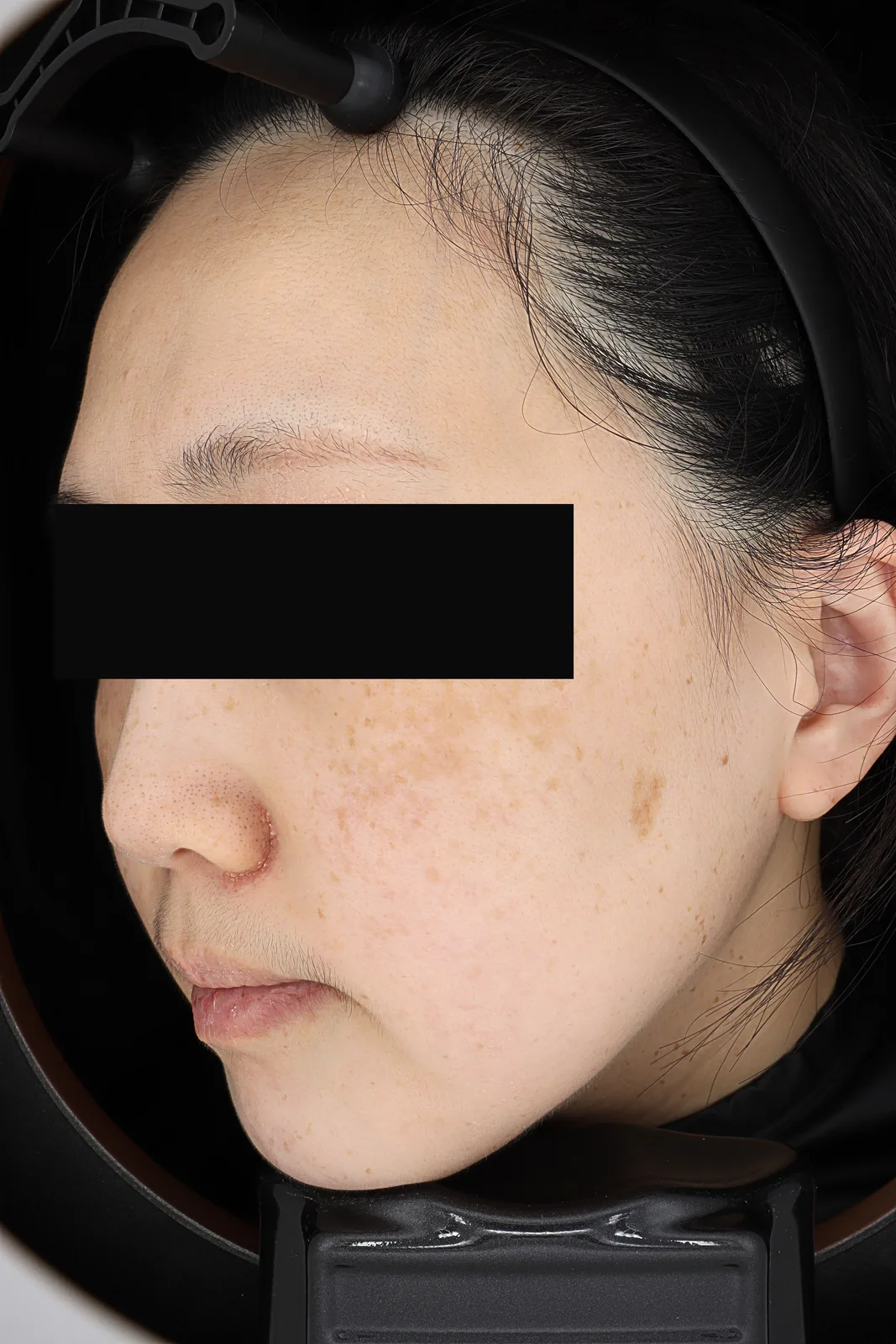 Dark Spot Removal (PicoCare) — Before, Kind Global Clinic Myeongdong