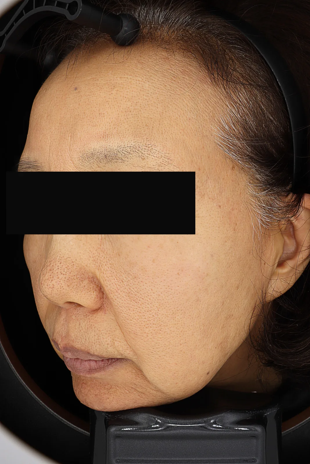 Dark Spot Removal (PicoCare) — After, Kind Global Clinic Myeongdong