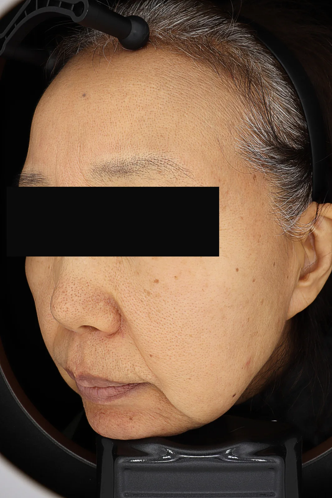 Dark Spot Removal (PicoCare) — Before, Kind Global Clinic Myeongdong
