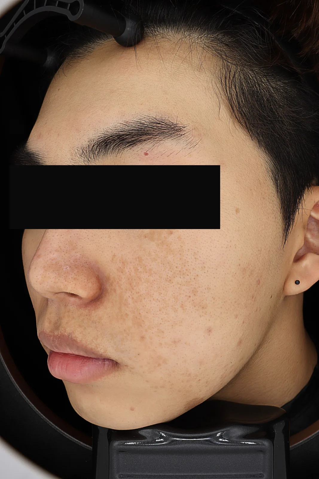 除斑雷射 (PicoCare) — 治療前, Kind Global Clinic Myeongdong