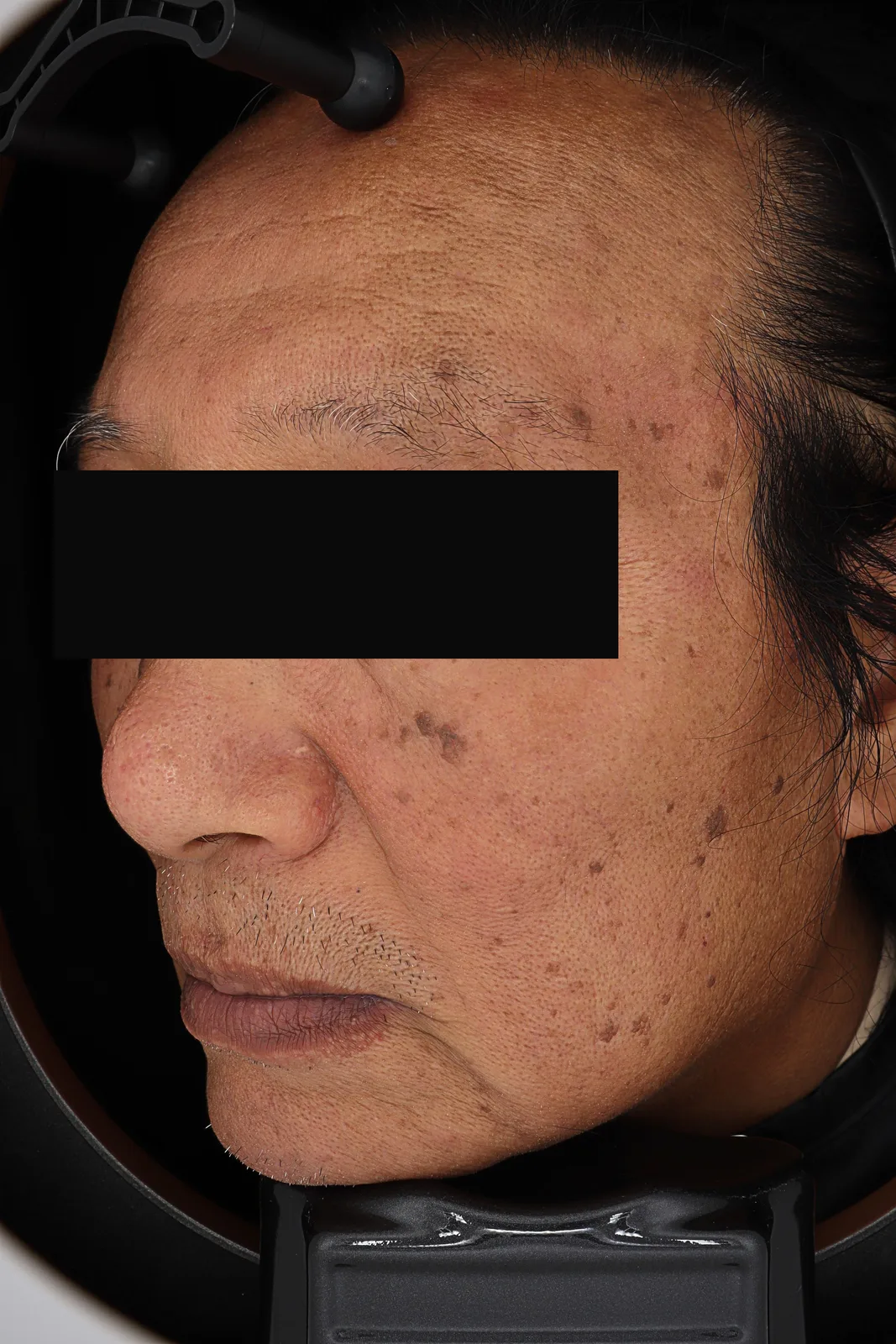 除斑雷射 (PicoCare) — 治療前, Kind Global Clinic Myeongdong