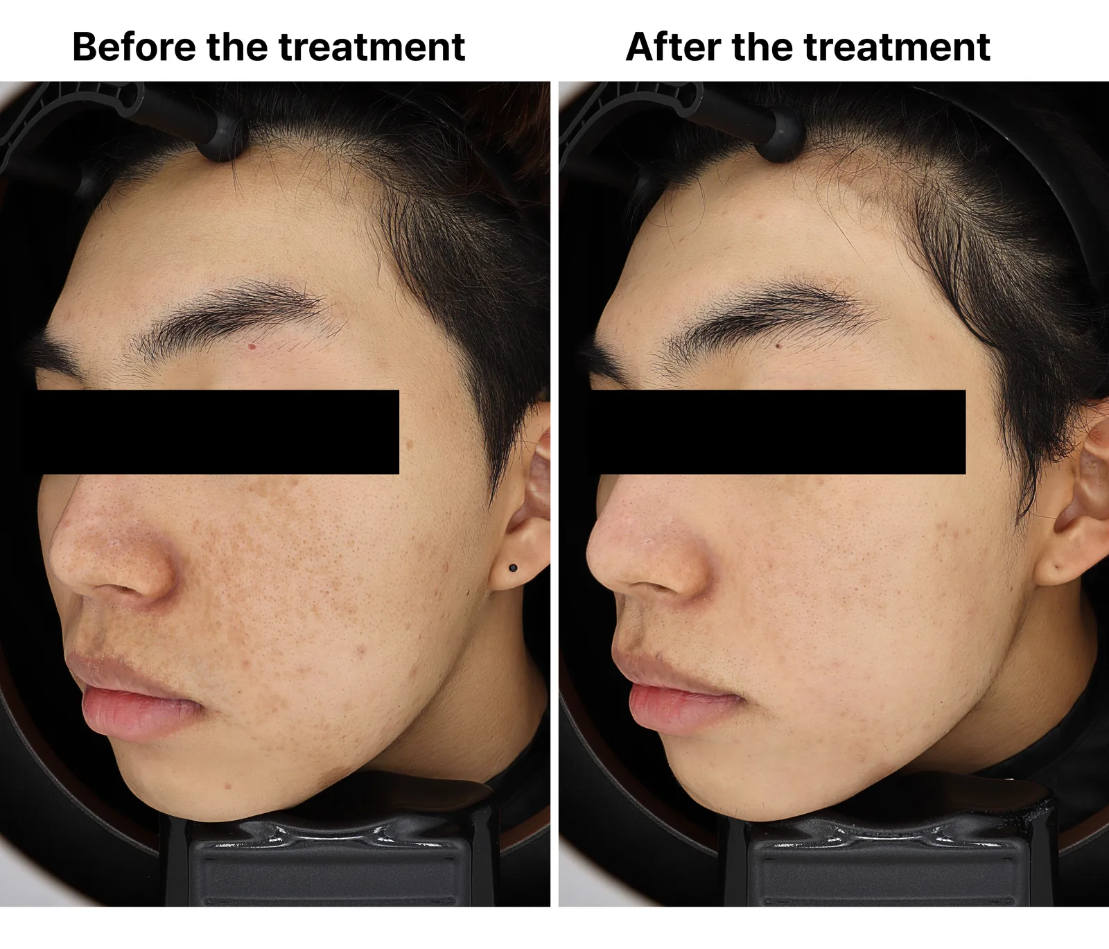 Pico Toning + Pico Fracxel + Genesis Toning — Before/After, Kind Global Clinic Myeongdong