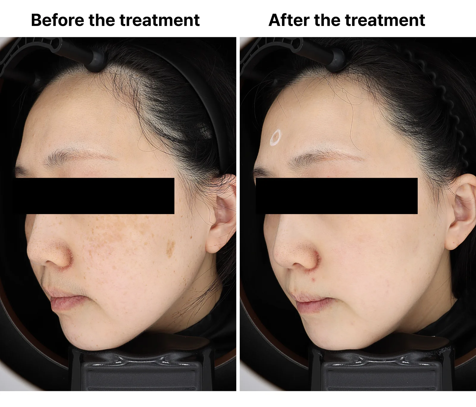 Pico Toning + Pico Fracxel + Genesis Toning — Before/After, Kind Global Clinic Myeongdong