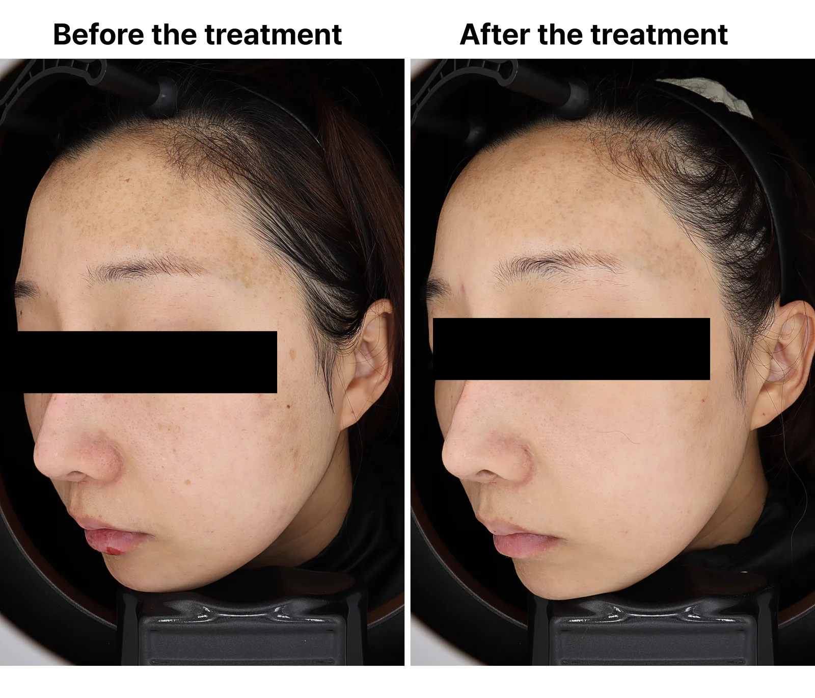 Pico Toning + Pico Fracxel + Pico Zoom + Genesis Toning — Before/After, Kind Global Clinic Myeongdong