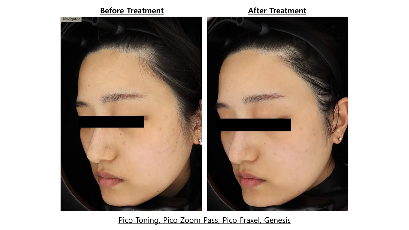 Pico Toning + Pico Fracxel + Pico Zoom + Genesis Toning — Before/After, Kind Global Clinic Myeongdong
