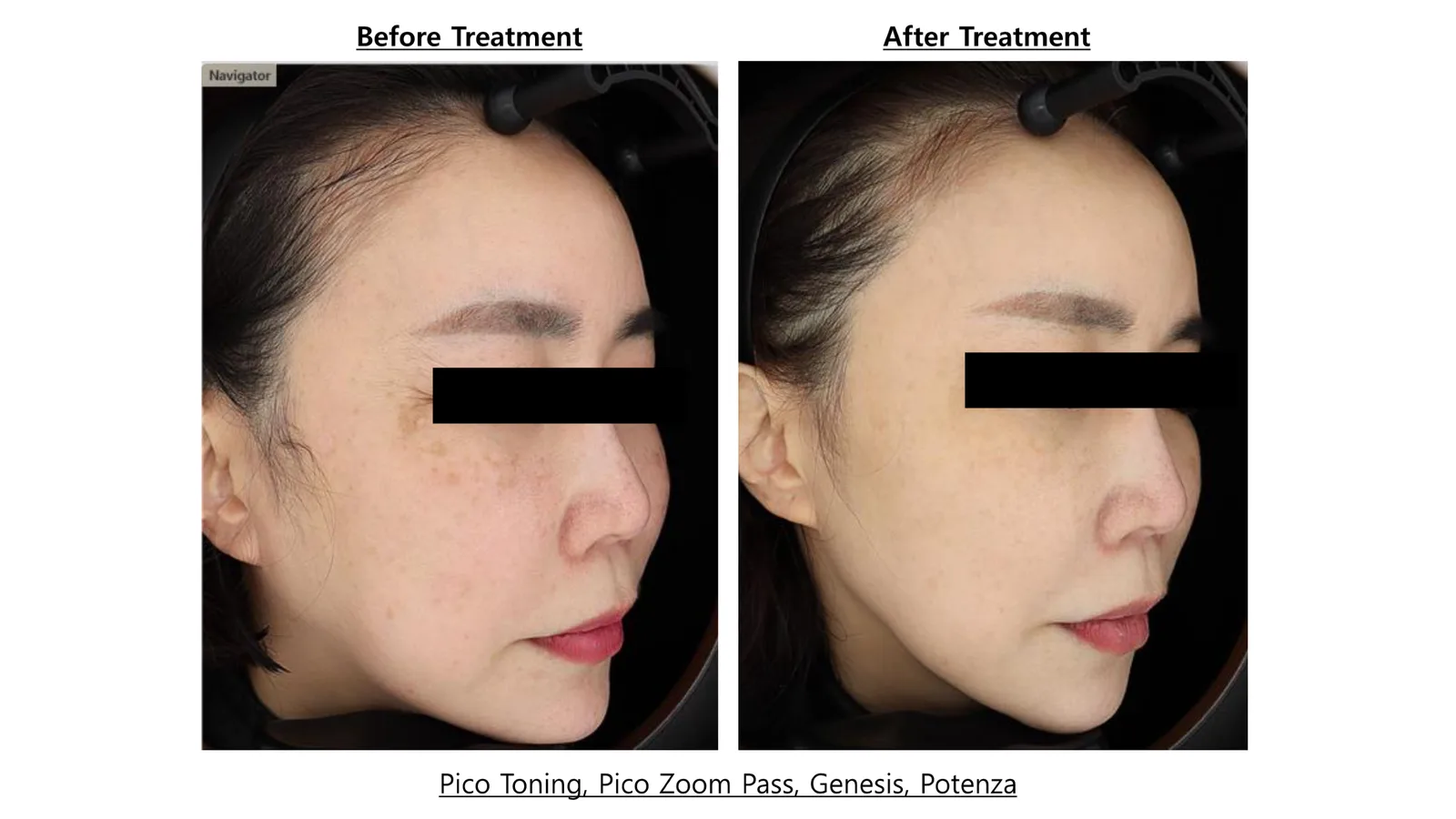 Pico Toning + Pico Zoom + Genesis Toning + Potenza — Before/After, Kind Global Clinic Myeongdong