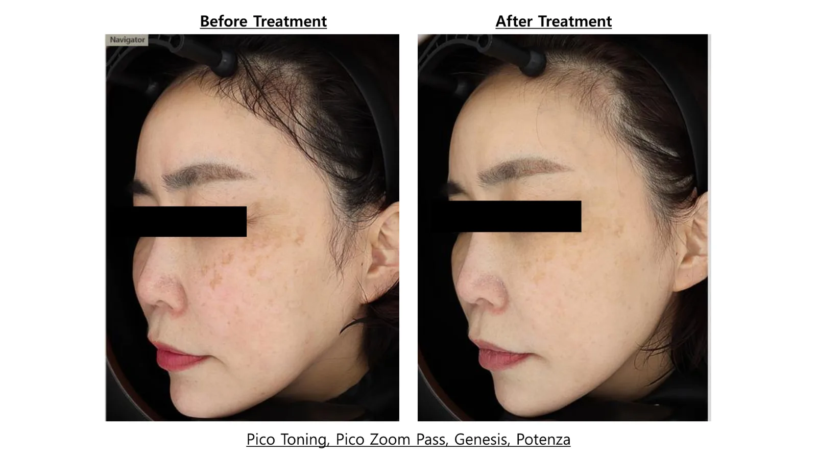 Pico Toning + Pico Zoom + Genesis Toning + Potenza — Before/After, Kind Global Clinic Myeongdong