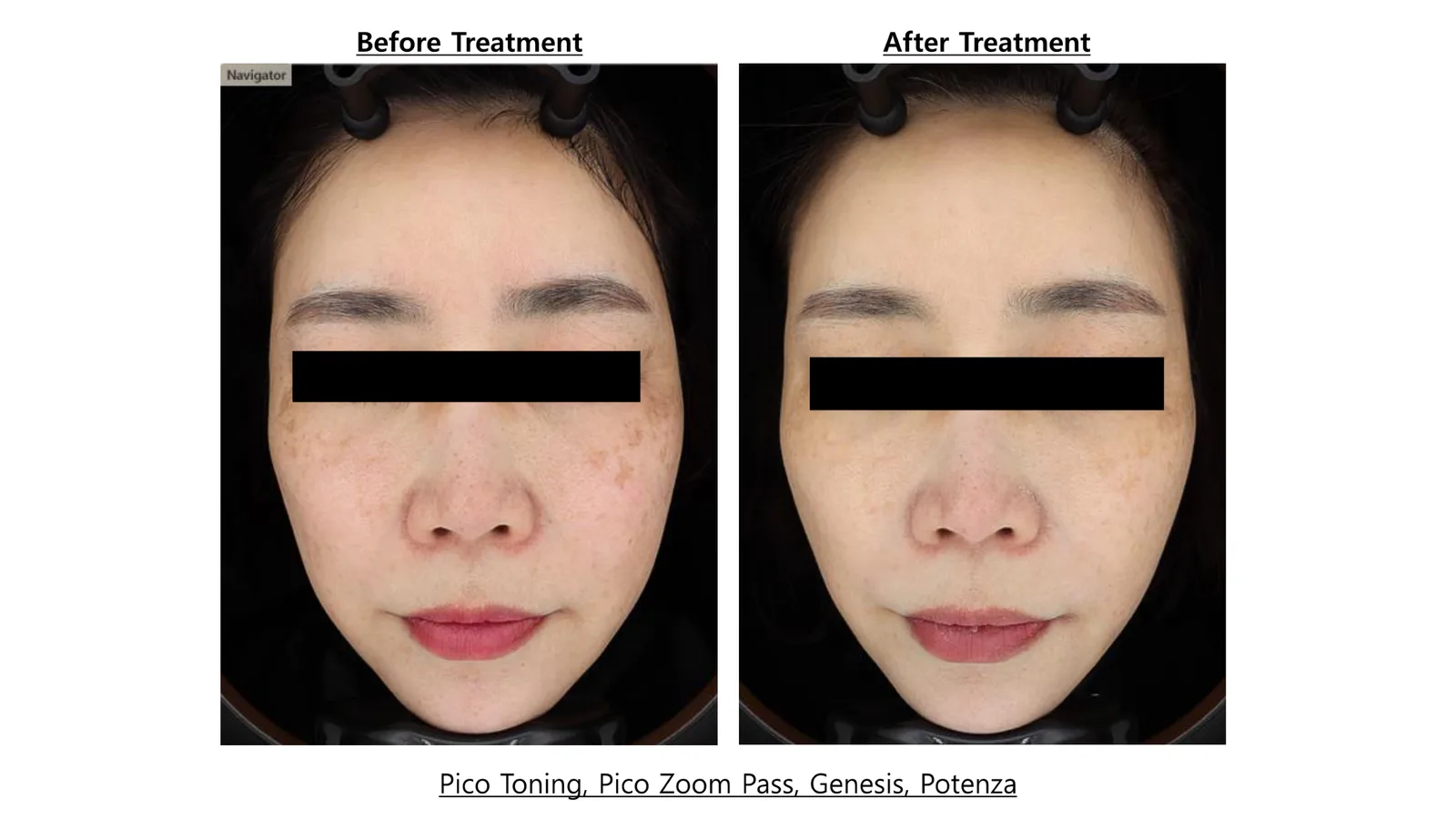 Pico Toning + Pico Zoom + Genesis Toning + Potenza — Before/After, Kind Global Clinic Myeongdong