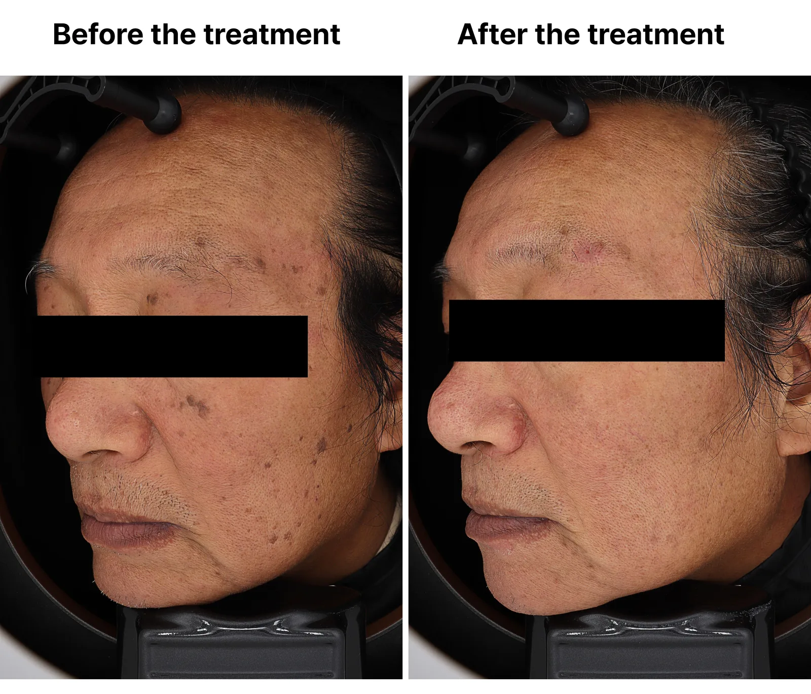 Pico Toning + Pico Zoom + Genesis Toning — Before/After, Kind Global Clinic Myeongdong