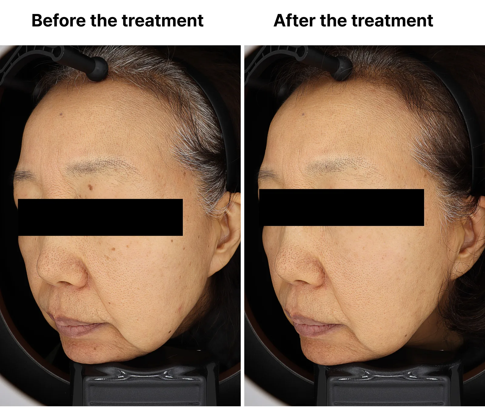 Pico Toning + Pico Zoom + Genesis Toning — Before/After, Kind Global Clinic Myeongdong