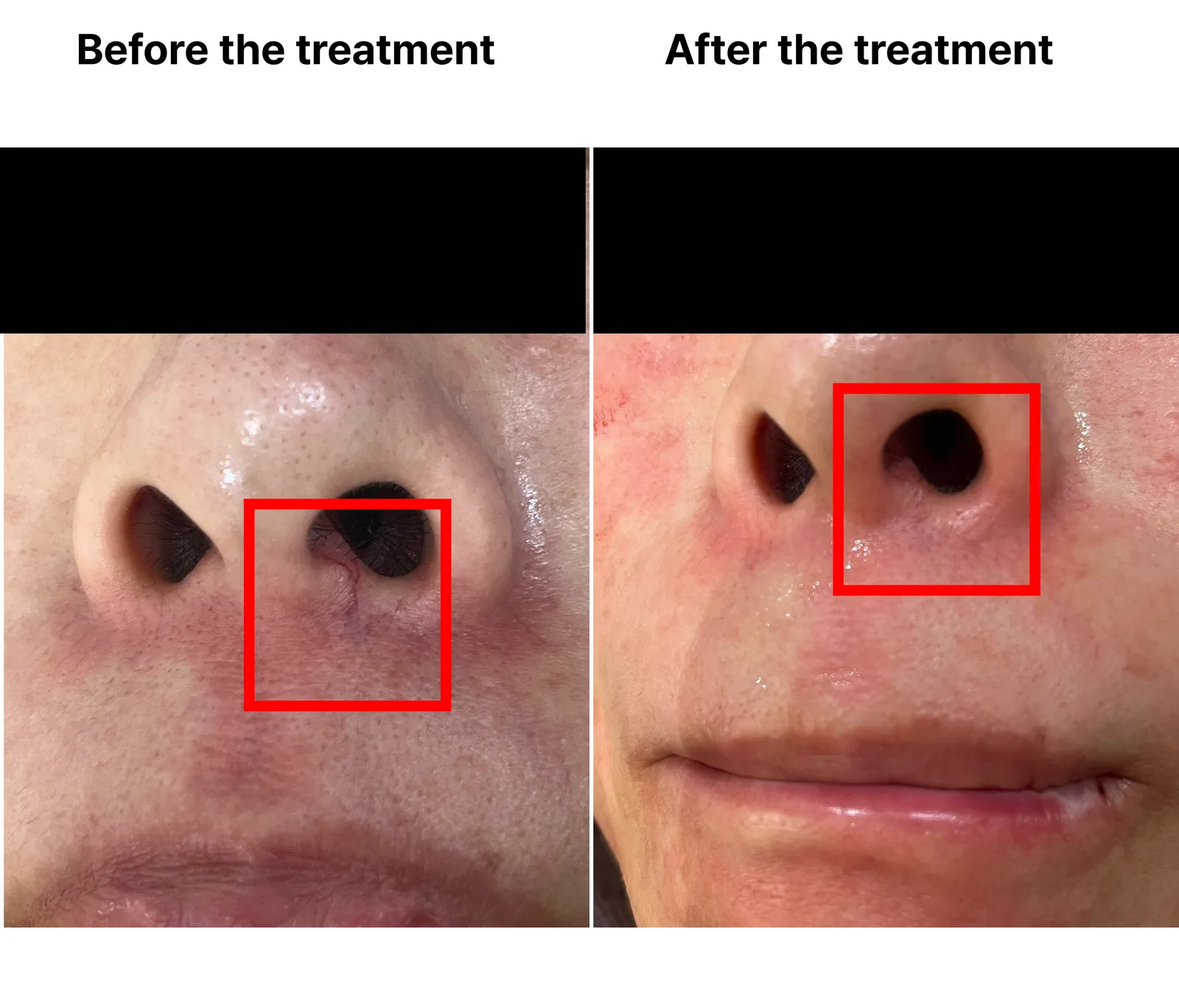 V-Laser Vascular — Before/After, Kind Global Clinic Myeongdong